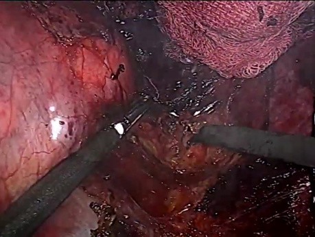 Laparoscopic Right Adrenalectomy for Giant (14 Cm) Adrenal Tumor