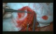 Right Open Hemicolectomy – Technical Principles - Part 4
