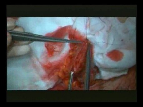 Right Open Hemicolectomy – Technical Principles - Part 4