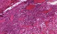 Peri-Appendiceal Abscess