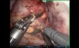 Robot Assisted Partial Nephrectomy in Ectopic Pelvic Kidney