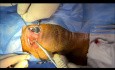 Wide Local Excision of Tongue Cancer