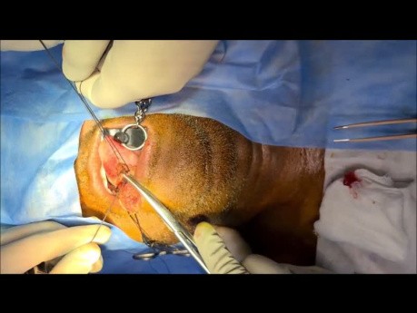 Wide Local Excision of Tongue Cancer