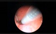 Essure Placement in Oficce