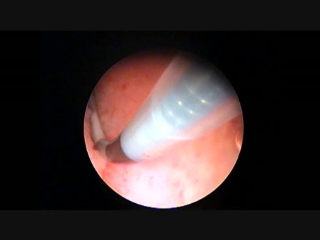Essure Placement in Oficce