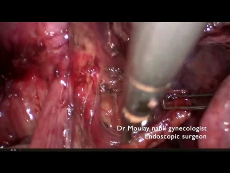 Recto Vaginal and Utero Sacral Endometriosis Management
