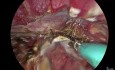 vNOTES Hysterectomy for Adenomyosis