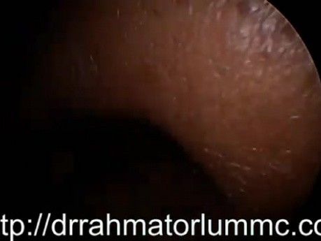 Polypoid Left Middle Turbinate and Right Sided Nasal Polyp 