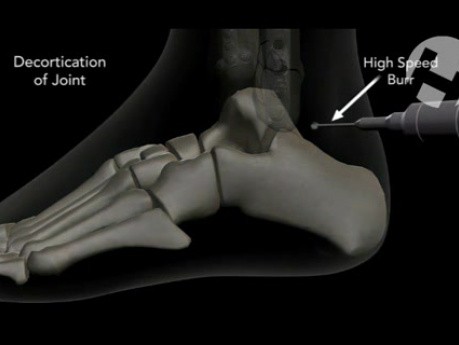 Subtalar Arthrodesis