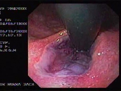Banding of Esophageal Varices - Cardias in Retroflexed View
