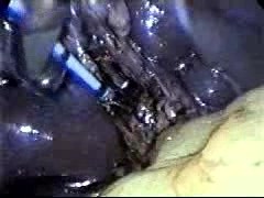 Gallstones - Laparoscopic Treatment