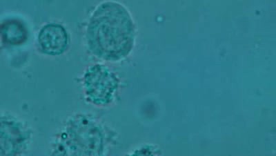 Human prostatic secretions - Prostatitis - Leucocytosis