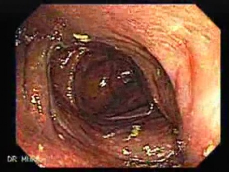 Melanosis Coli (1 of 5)