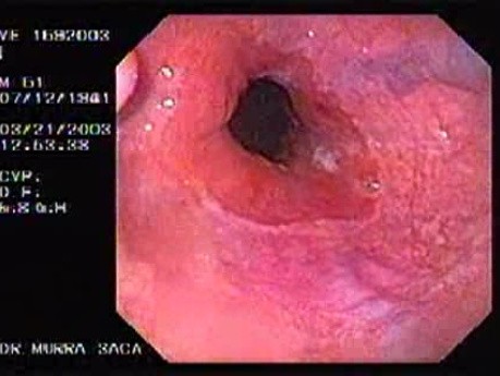 Banding of esophageal varices - insertion of the endoscope
