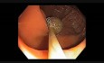 Colonoscopy Channel - How To Perform EMR - Lesion G