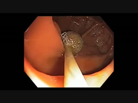 Colonoscopy Channel - How To Perform EMR - Lesion G