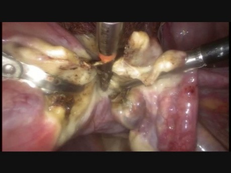 Sacrocolpopexy After 3 C-section Scars