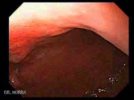 Adenocarcinoma of the Lesser Curvature with Signet Ring Cells (1 of 8)