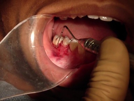 Part 8/8: Root Coverage Surgery - Mandibular Premolar - Completed Overview