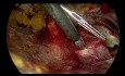 TEP Hernia Repair Using Self Fixating Mesh (full video edited only for dead time)