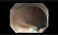 Colonoscopy - Sigmoid Colon EMR as an alternative to surgery
