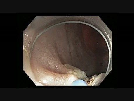 Colonoscopy - Sigmoid Colon EMR as an alternative to surgery