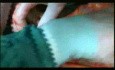 Open Right Hemicolectomy – Technical Principles - Operation No 1 - Part 3