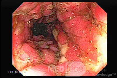 Massive Rectal Bleeding (11 of 11)