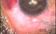 A iris claw lens - 15 years after surgery