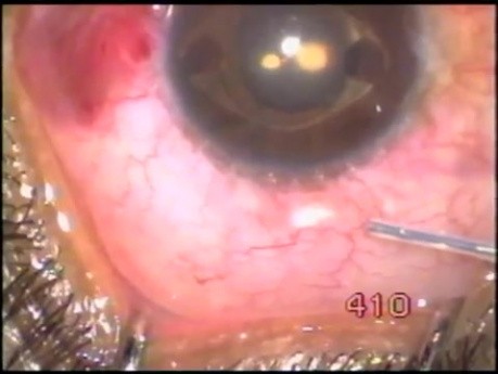 A iris claw lens - 15 years after surgery