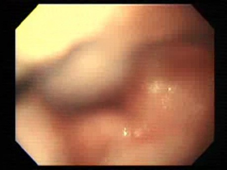 Foreign Body Ingestion (5 of 7)