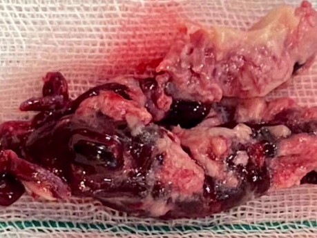 Patient with Primary Gastric Adenocarcinoma and Cardiovascular Metastasis