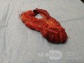 Ischemic Colitis