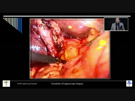Laparoscopic Management of CBD Stone