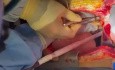 Heart and Lungs Donation after Complete Cardiac Death - Part 1 