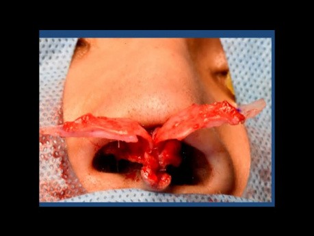 Correction of Under Projected Nasal Tip