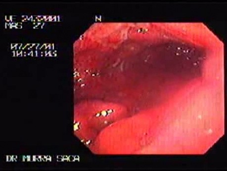 Linitis Plastica - Endoscopy