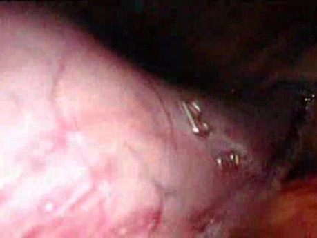 Gastrointestinal Stromal Tumor - GIST (52 of 65)
