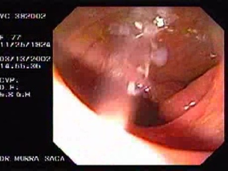 Adenocarcinoma Of The Transverse Colon - Endoscopy (2 of 9)