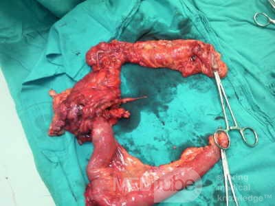 Non-Hodgkin's Lymphoma of the Colon (5 of 16)