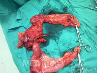 Non-Hodgkin's Lymphoma of the Colon (5 of 16)