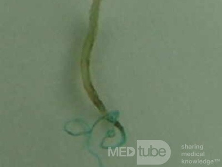 Trichuris Trichuris (whipworm) (8 of 10)