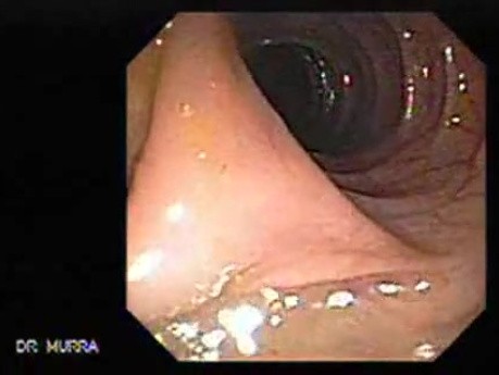 Polypectomy of Stalked Polyp (2 of 6)