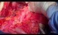 Ovarian Cancer Cytoreductive Surgery. Unedited version. Part II Middle Abdomen.