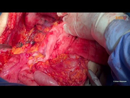 Ovarian Cancer Cytoreductive Surgery. Unedited version. Part II Middle Abdomen.