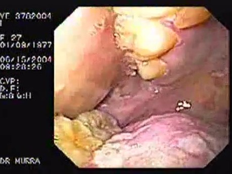 Oropharynge-Esophagic Candidiasis (3 of 5)