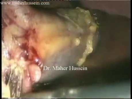 Cholecystectomy - Laparoscopic Approach