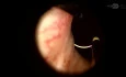 Transurethral Management of Prostate Abscess