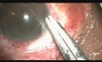 Drainage from Suprachoroidal Space in a Special Situation/Case