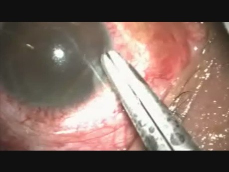 Drainage from Suprachoroidal Space in a Special Situation/Case